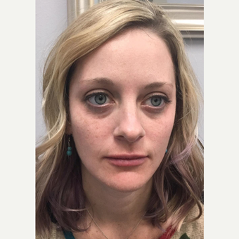 25-34 year old woman treated with Liquid Facelift after 3684400