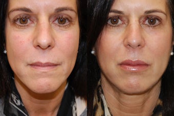 Lip Augmentation with Silikon-1000. 2 treatments. before 430182