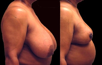Large breast reduction before 1141922
