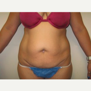 45-54 year old woman treated with Tummy Tuck before 1733924