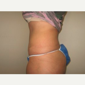 45-54 year old woman treated with Tummy Tuck 1733924