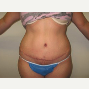 45-54 year old woman treated with Tummy Tuck after 1733924