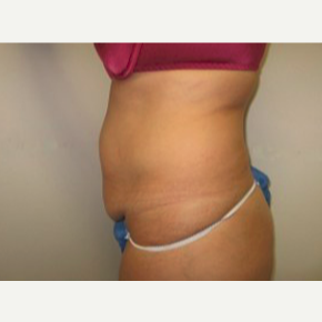 45-54 year old woman treated with Tummy Tuck 1733924