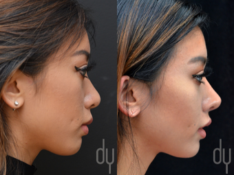 Asian Rhinoplasty with Rib cartilage before 3739406