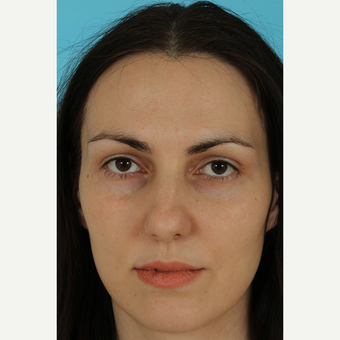 25-34 year old woman treated with Rhinoplasty before 3690793