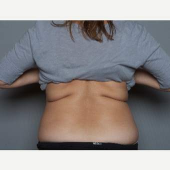 55-64 year old woman treated with SculpSure before 3584214