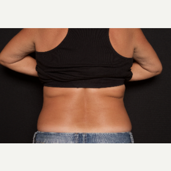 55-64 year old woman treated with SculpSure after 3584214