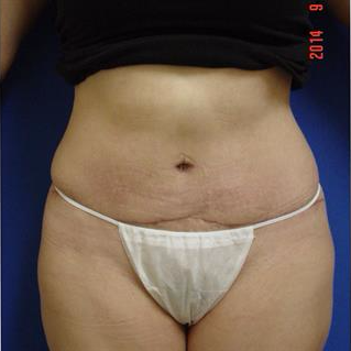 35-44 year old woman treated with Liposuction after 3285109