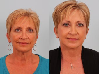 Mini Face Lift before 249305