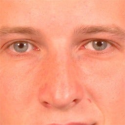 Rhinoplasty after 1675866