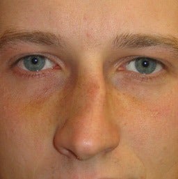 Rhinoplasty before 1675866