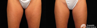 CoolSculpting® of the Inner Thighs before 1459111