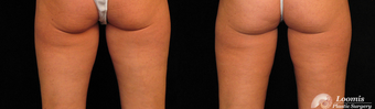CoolSculpting® of the Inner Thighs after 1459111