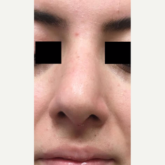 18-24 year old man treated with Nose Surgery after 3809210