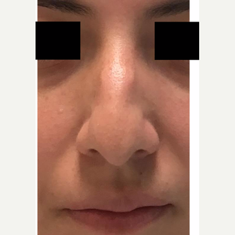 18-24 year old man treated with Nose Surgery before 3809210