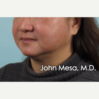 55-64 year old woman treated with Buccal Fat Removal before 3777316