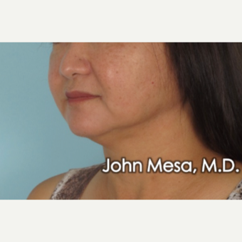 55-64 year old woman treated with Buccal Fat Removal after 3777316