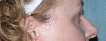 Laser Skin Resurfacing Around Eye Area after 1064643