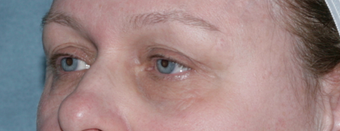 Laser Skin Resurfacing Around Eye Area 1064643