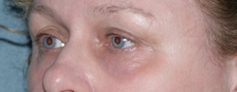Laser Skin Resurfacing Around Eye Area 1064643