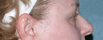 Laser Skin Resurfacing Around Eye Area before 1064643