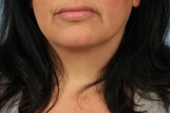 45-54 year old woman treated with Lip Implants after 3615546