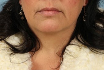 45-54 year old woman treated with Lip Implants before 3615546