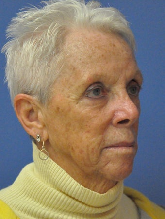 Basal cell carcinoma MOHs surgery - MOHs Reconstruction after 1039526