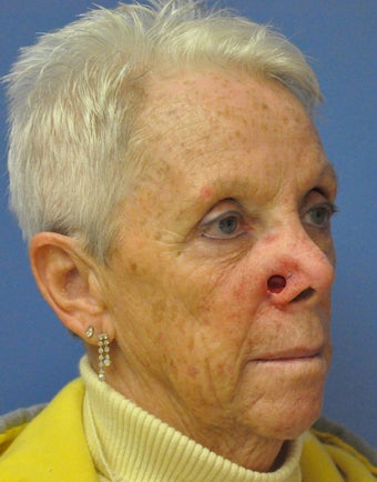Basal cell carcinoma MOHs surgery - MOHs Reconstruction before 1039526