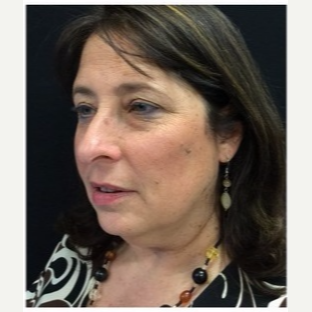 55-64 year old woman treated with Facelift before 3088080