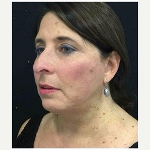 55-64 year old woman treated with Facelift after 3088080