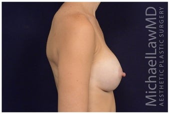 Breast Augmentation after 1326164