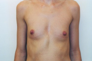Breast asymmetry correction with Breast Augmentation before 3103556