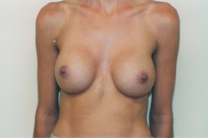 Breast asymmetry correction with Breast Augmentation after 3103556