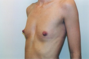 Breast asymmetry correction with Breast Augmentation 3103556