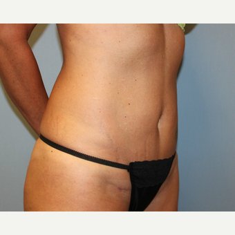 35-44 year old woman treated with Tummy Tuck after 3815719