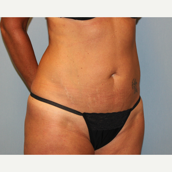 35-44 year old woman treated with Tummy Tuck before 3815719