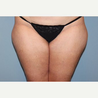 45-54 year old woman treated with Liposuction before 3588275
