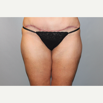 45-54 year old woman treated with Liposuction after 3588275