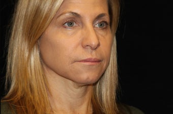 45-54 year old woman treated with Liquid Facelift 3502837