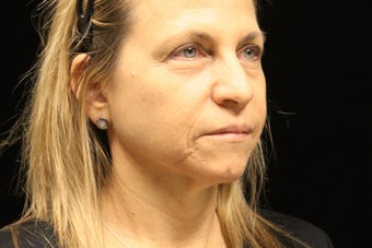 45-54 year old woman treated with Liquid Facelift 3502837
