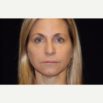 45-54 year old woman treated with Liquid Facelift after 3502837