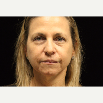 45-54 year old woman treated with Liquid Facelift before 3502837