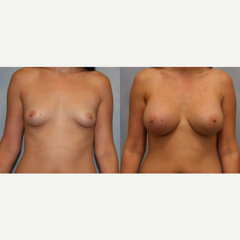 25-34 year old woman treated with Breast Augmentation before 3440407