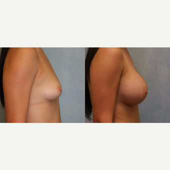 25-34 year old woman treated with Breast Augmentation after 3440407