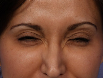Botox for Crows Feet after 322714