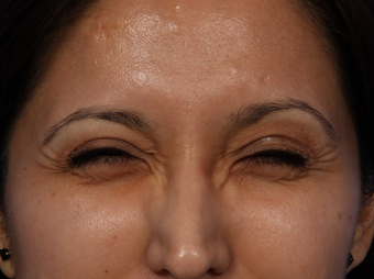 Botox for Crows Feet before 322714