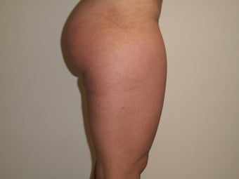 Scar Revision after 1360051
