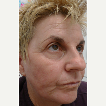 Laser resurfacing - for extreme sun damage after 3133553
