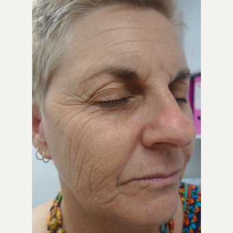 Laser resurfacing - for extreme sun damage before 3133553